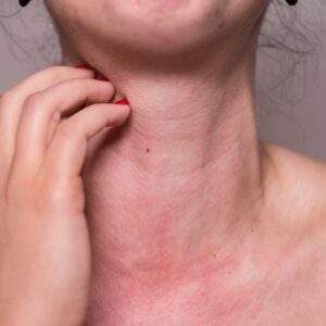 CAPA BLOG 10 300x300 - Hipoalergênico não é antialérgico: skincare não é para crianças